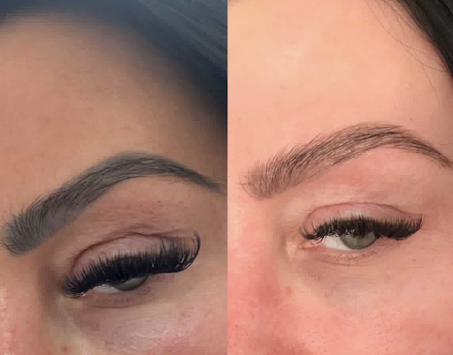 Tattoo Removal Progress