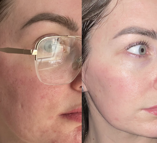 CO2 Skin Resurfacing Results