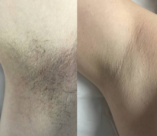 Laser Hair Reduction Results